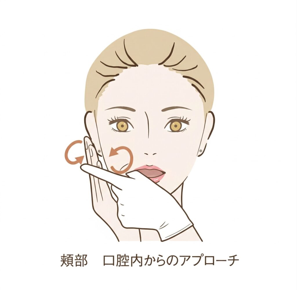 顔面神経麻痺急性期におけるリハビリテーション手技の図解（頬部に対する口腔内からのアプローチ）。顔面神経麻痺診療ガイドライン2023年版を参考に鍼灸指圧 豊田治療院が作成